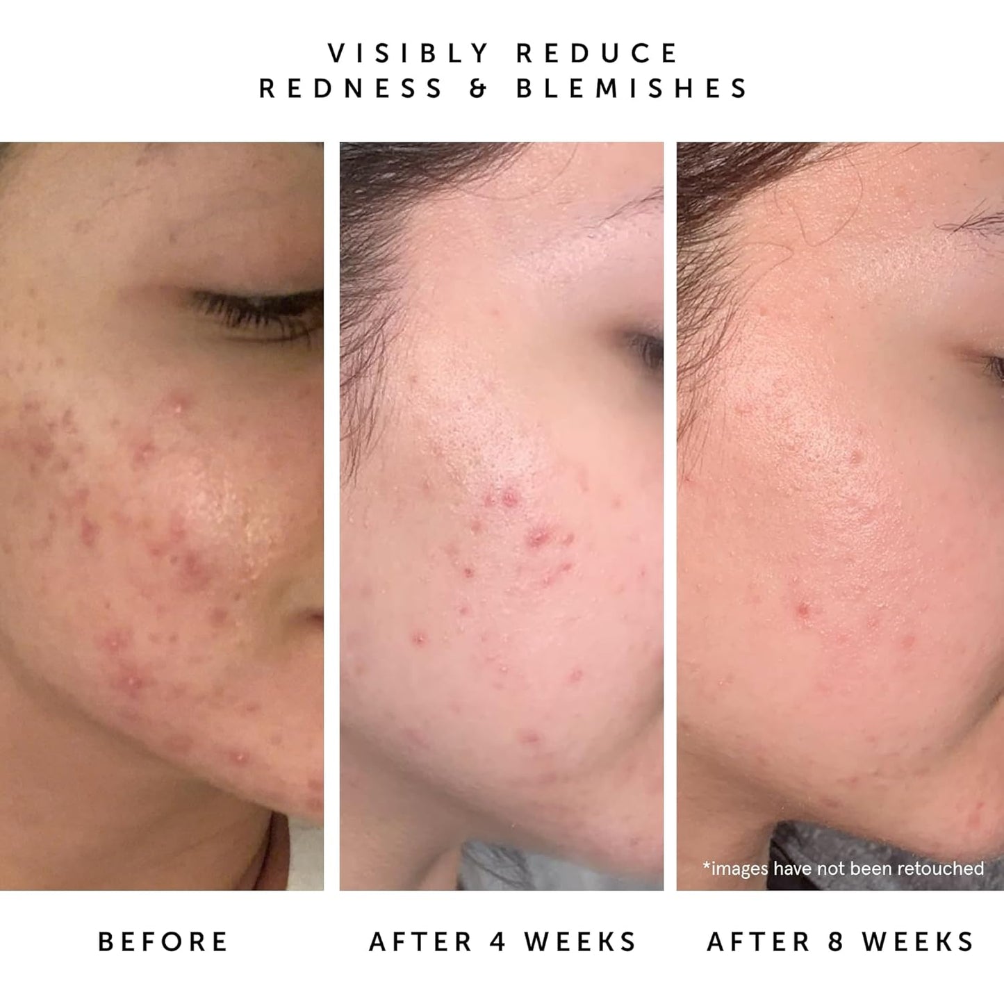 HERBIVORE Lapis Balancing Facial Oil with Blue Tansy + Squalane, Safe for Acne-Prone Skin | Helps Soothe Redness + Balance Oil Production, Lightweight, Non-Comedogenic, Plant-Based