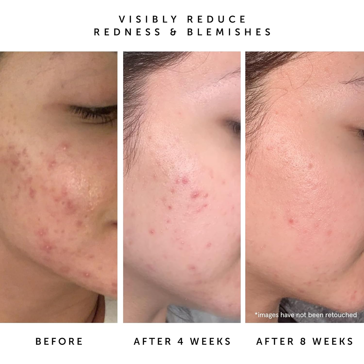 HERBIVORE Lapis Balancing Facial Oil with Blue Tansy + Squalane, Safe for Acne-Prone Skin | Helps Soothe Redness + Balance Oil Production, Lightweight, Non-Comedogenic, Plant-Based