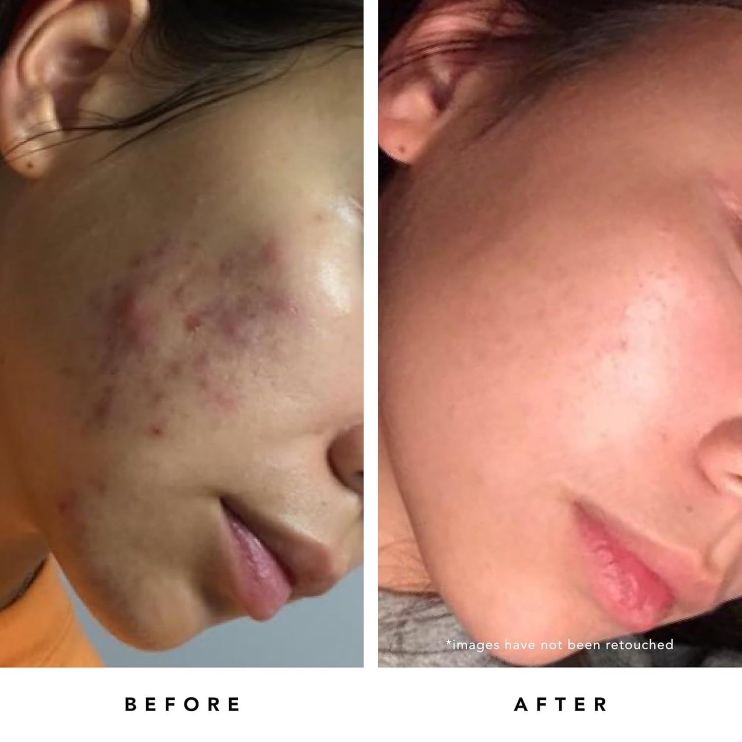 HERBIVORE Blue Tansy BHA & Enzyme Pore Refining Mask - Naturally Clarifies Acne, Blemishes & Redness, Vegan & Cruelty-Free, 60 mL / 2.02 oz