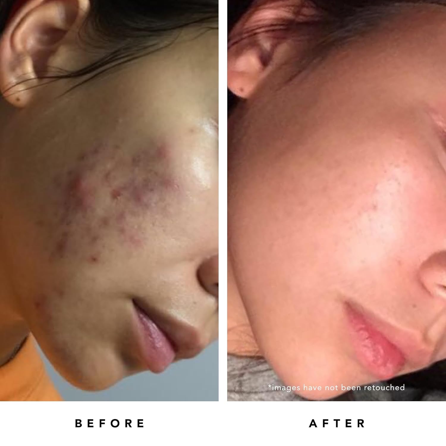 HERBIVORE Blue Tansy BHA & Enzyme Pore Refining Mask - Naturally Clarifies Acne, Blemishes & Redness, Vegan & Cruelty-Free, 60 mL / 2.02 oz